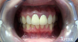 Porcelain Crowns