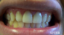 Porcelain Crowns