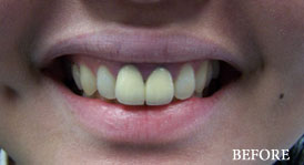 Porcelain Crowns