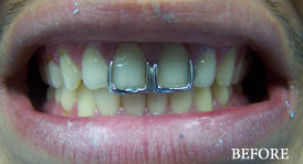 Porcelain Crowns