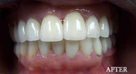 Smile Make Over