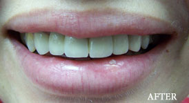 Smile Make Over