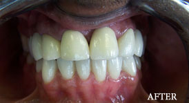 Smile Make Over