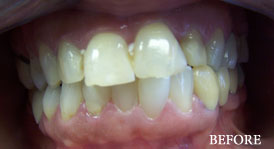 Smile Make Over