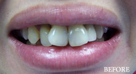 Smile Make Over