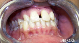 Smile Make Over
