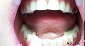 Teeth Whitening