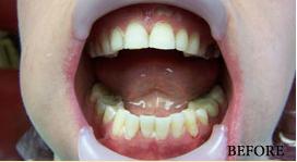 Teeth Whitening