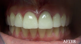 Porcelain Veneers