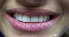 Porcelain Veneers