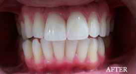 Porcelain Veneers
