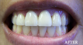 Porcelain Veneers