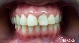 Porcelain Veneers