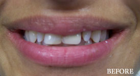 Porcelain Veneers