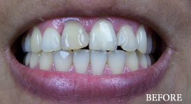 Porcelain Veneers